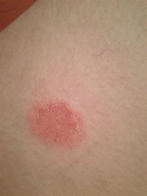 Any idea what this is? Appeared on my thigh randomly. Have been assuming its just dry skin (as i ...