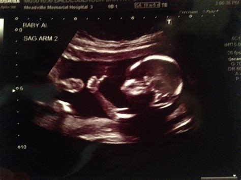 This baby: | Ultrasound, Funny pictures, Ultrasound pictures