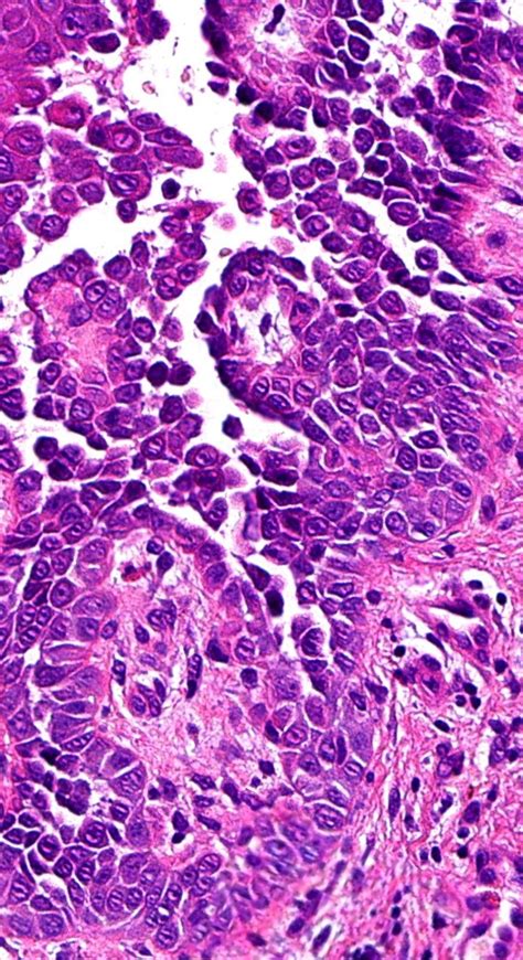 Pathology of Hailey-Hailey Disease in 2022 | Grover disease, Basal cell ...