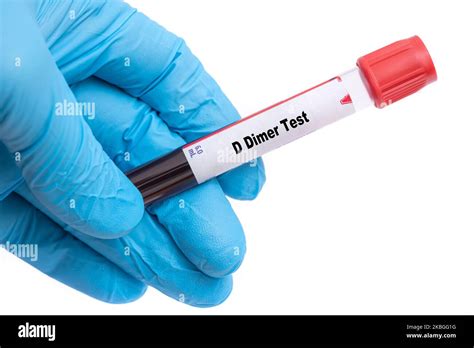 D Dimer Test Medical check up test tube with biological sample Stock Photo - Alamy