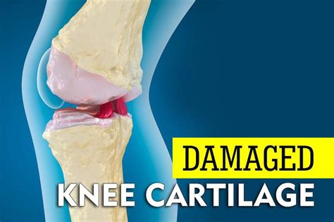 The Best Exercises for Damaged Knee Cartilage | Torn cartilage in knee, Knee cartilage repair ...