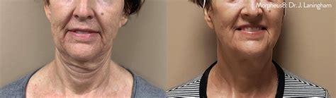 FaceTite Portland | Non-Surgical Face Lift Portland, Oregon