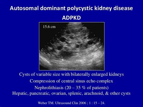 MEDICAL SCHOOL: MEDICAL ULTRASOUND/POLYCYSTIC KIDNEY | Ultrasound ...