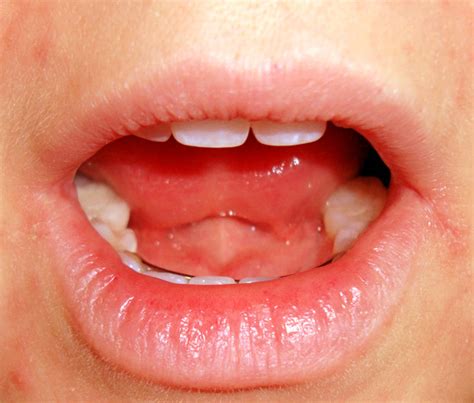 Angular Cheilitis (Perleche, Angular Stomatitis, Cheilosis) - Dermatology Advisor