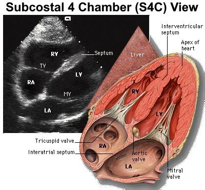 Subcostal 4 Chamber | Point of Care Ultrasound