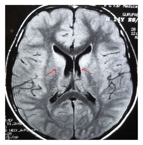 MRI (T2 FLAIR) showing hyperintensities of both caudate nuclei. | Download Scientific Diagram