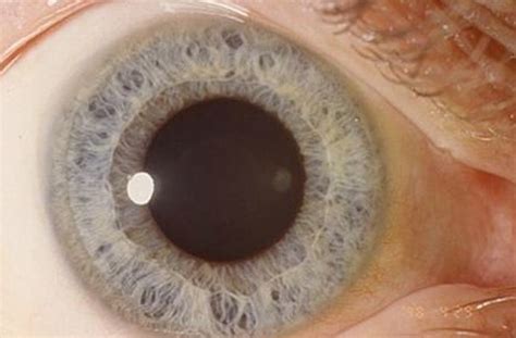 Mydriasis - Symptoms, Causes, Treatment, Pictures