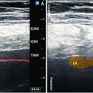 Sonoanatomy for transversalis fascia plane block. (A) The red line... | Download Scientific Diagram