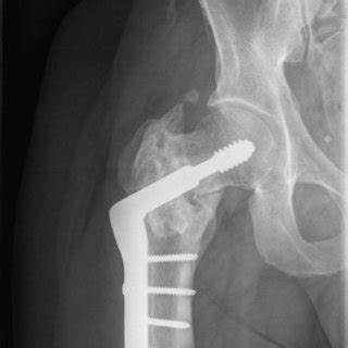 Two years after closed reduction and percutaneous pinning of a two-part... | Download Scientific ...