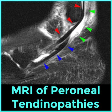 MRI Findings of Peroneal Tendon Pathology - Sports Medicine Review