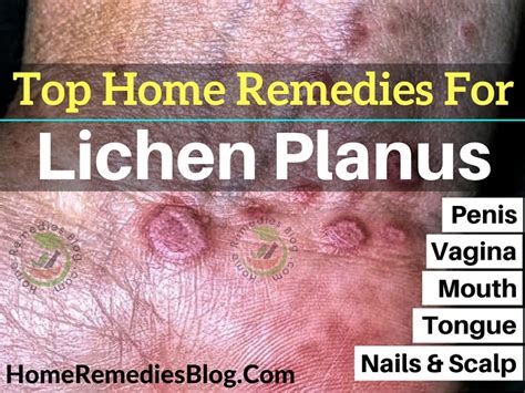 11 Proven Home Remedies To Treat Lichen Planus Naturally - Home Remedies Blog