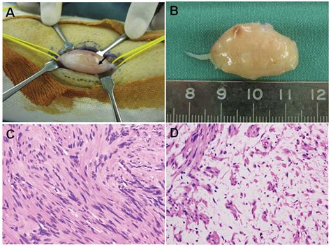 Solitary schwannoma of the sural nerve: An unusual clinical presentation