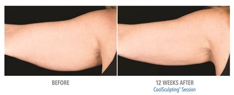 Finally, a Fix for Flabby Arms | Laser Aesthetic Center