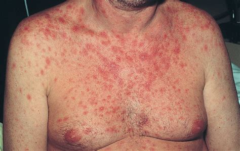 A Maculopapular Rash in a Patient With Severe Diarrhea | Dermatology ...