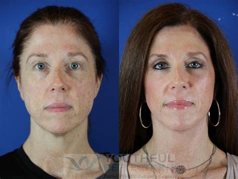 CO2 Laser Skin Resurfacing Before & After Photos Patient 49 | Nashville, TN | Youthful Reflections