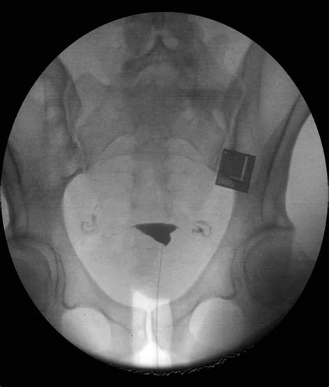 Hysterosalpingogram procedure, uses & hysterosalpingogram side effects