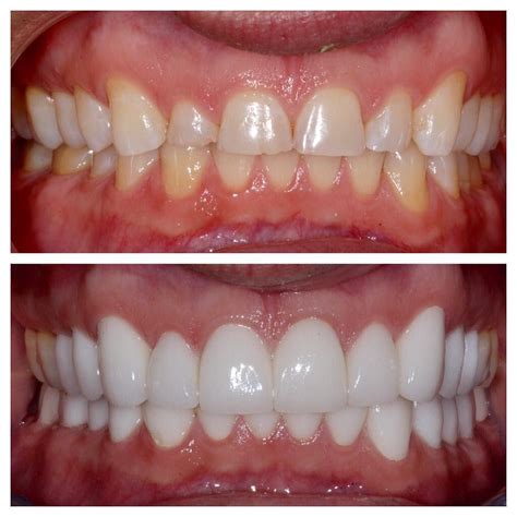 Dr. Sol Weiss on Instagram: “This patient improved his smile with porcelain jacket crowns # ...