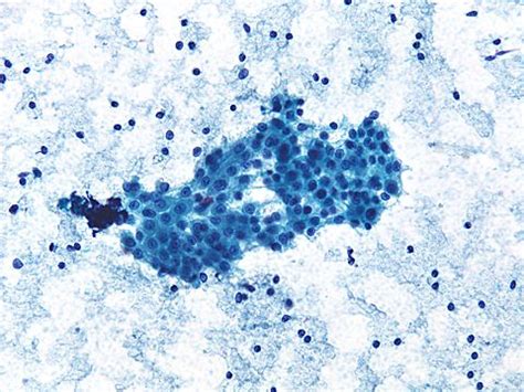 Warthin tumor. two diagnostic features of Warthin tumor: oncocytic epithelium and lymphocytes ...