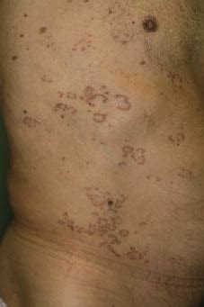 Scrofuloderma Associated with Granuloma Annulare-like Lichen Scrofulosorum | HTML | Acta Dermato ...