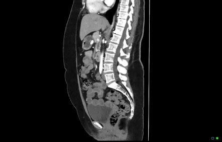 Normal CTA abdomen and pelvis | Image | Radiopaedia.org