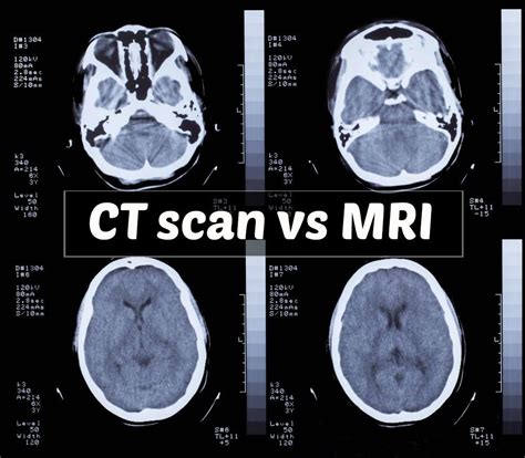 Mri, Ct scan, Mri scan