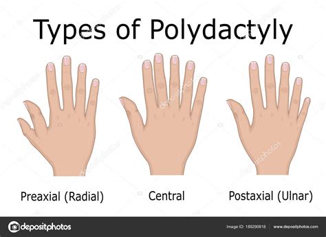 23+ Polydactyly Thumb - Furry Kittens