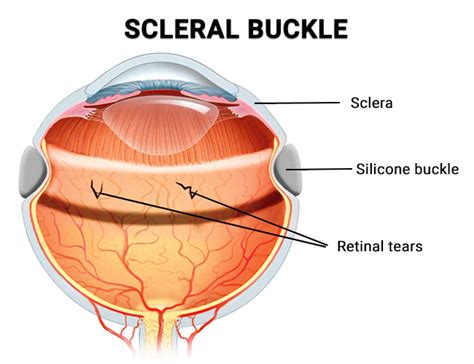 Scleral Buckle Procedure - Vitreous Retina Macula Consultants of New York