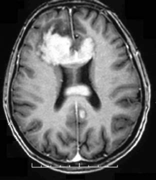 Primary CNS Lymphoma | Neupsy Key