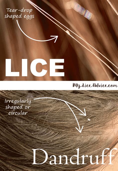 Lice vs Dandruff - 7 Key Differences Between Lice Eggs and Dandruff