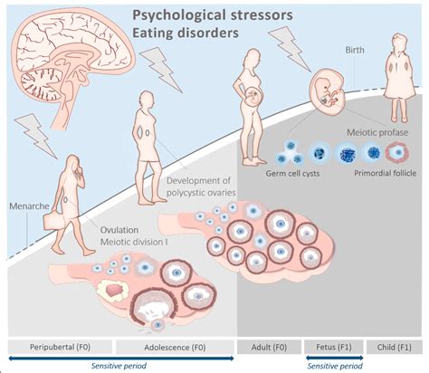 IJMS | Free Full-Text | Polycystic Ovary Syndrome: A Brain Disorder ...