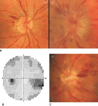 Optic Nerve Disorders | Ento Key