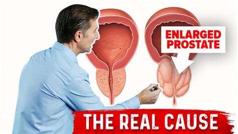 Enlarged Prostate and Urination Problems | Healthy Keto™ Dr. Berg