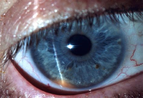 Iris-Ciliary Body Melanoma. EyeRounds.org - Ophthalmology - The University of Iowa