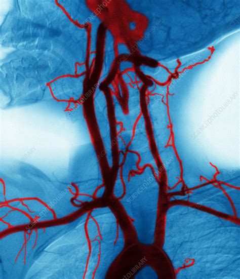 Angiogram of Carotid Arteries - Stock Image - C009/4657 - Science Photo Library