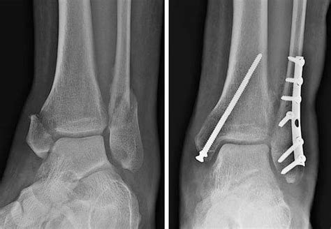 What is ankle fracture surgery? - Orthopedic Specialists of Seattle