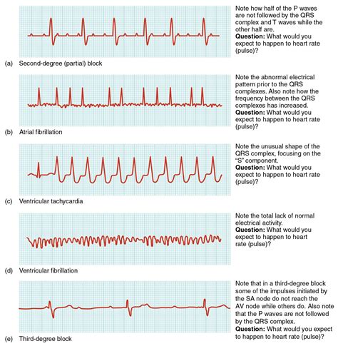 Dysrhythmia Interpretation Certificate | TUTORE.ORG - Master of Documents