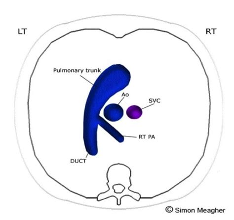 Normal fetal echocardiogram | Radiology Case | Radiopaedia.org | Diagnostic medical sonography ...