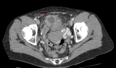 Cureus | Appendiceal Adenocarcinoma Presenting As Perforated Appendicitis