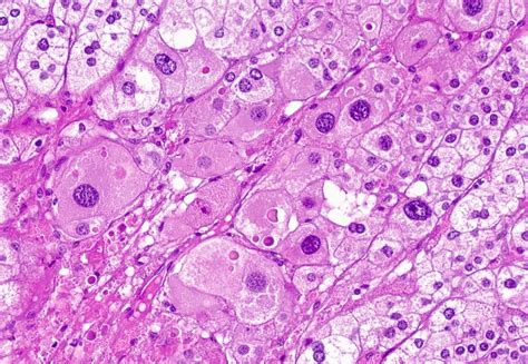 Pathology Outlines Histologyadrenal Cortex