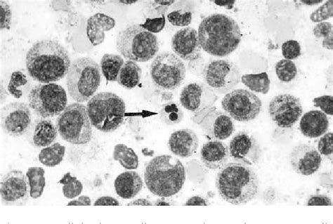 Figure 1 from Fine Needle Aspiration of Extramedullary Myeloid Cell Tumor in Myelodysplastic ...