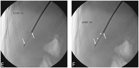 Liver Biopsy | Radiology Key