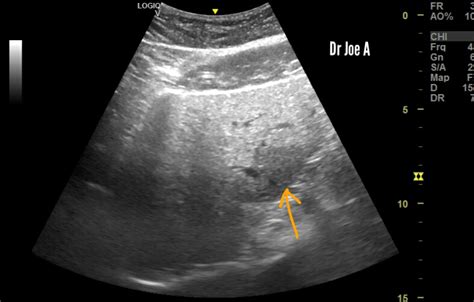 Ultrasound imaging: Focal-sparing-of-fatty-liver