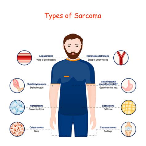 Cell and gene therapy for sarcomas | Alliance for Cancer Gene Therapy