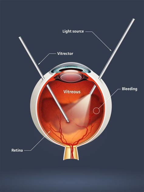 Vitreomacular Traction Syndrome | Posterior vitreous detachment, Eye health, Types of surgery