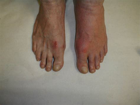 Gout (patient information) - wikidoc