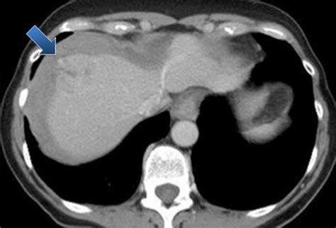 A 61-Year-Old Woman with Radiating Abdominal Pain: Case Presentation