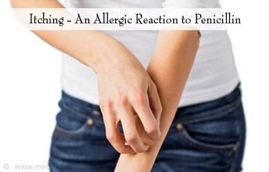 Penicillin Allergy - Causes, Symptoms, Risk Factors, Diagnosis, Treatment, Prevention