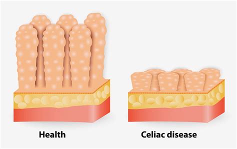 Coeliac Disease | Oxford Gut and Liver