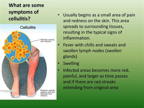 Cellulitis Causes