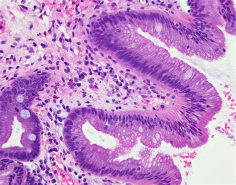 Pathology Outlines - Barrett esophagus